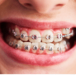 Why Orthodontists Still Choose Metal Braces for Severe Malocclusions in the Era of Clear Aligners