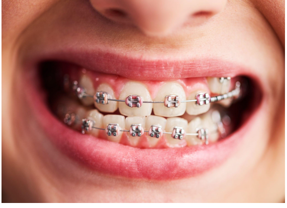 Why Orthodontists Still Choose Metal Braces for Severe Malocclusions in the Era of Clear Aligners
